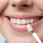 Veneer teeth Sydney