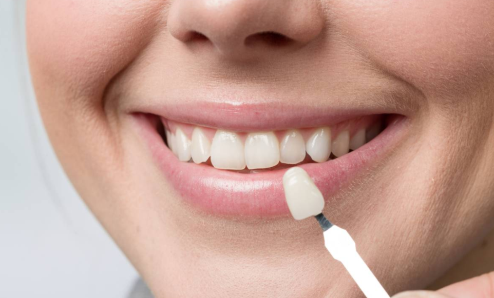 Veneer teeth Sydney