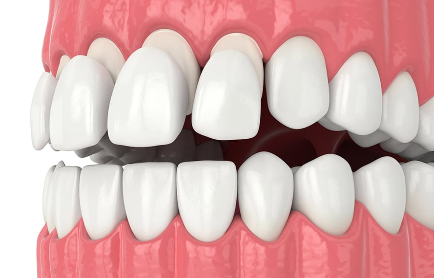 Veneer teeth Sydney
